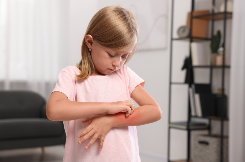 Suffering from a food allergy, a little girl scratches her arm.