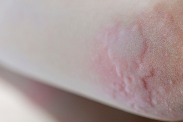 Suffering from a food allergy, a little girl scratches her arm.