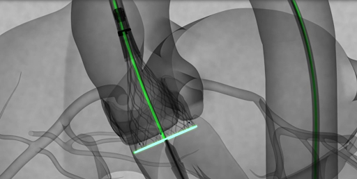 Illustration of the Evolute FX Transcatheter Aortic Valve Replacement system being deployed in the heart.