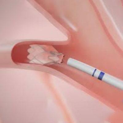 Zephyr Endobronchial Valve Treatment