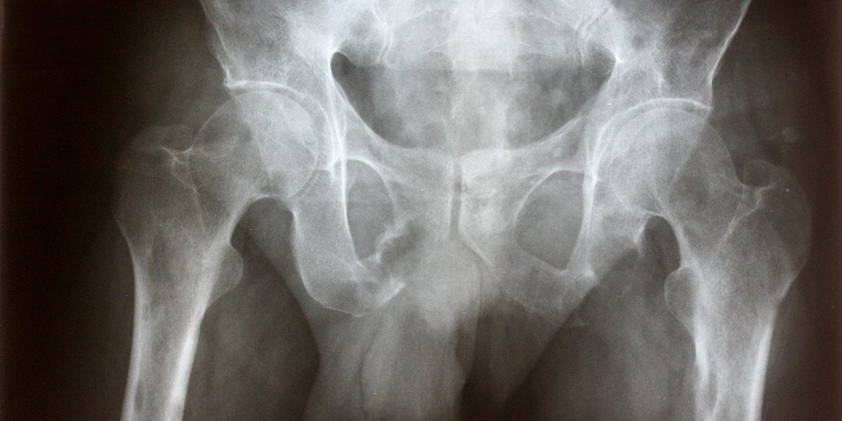 Sarcoma Treatment