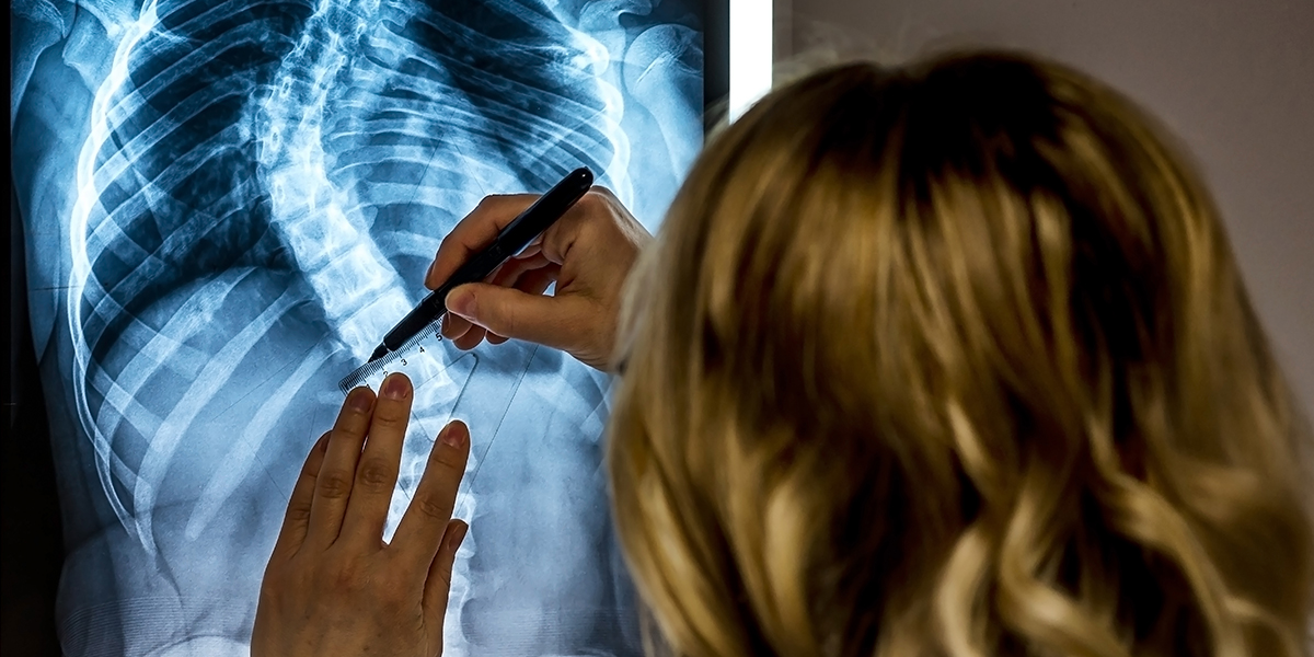 Scoliosis Treatment