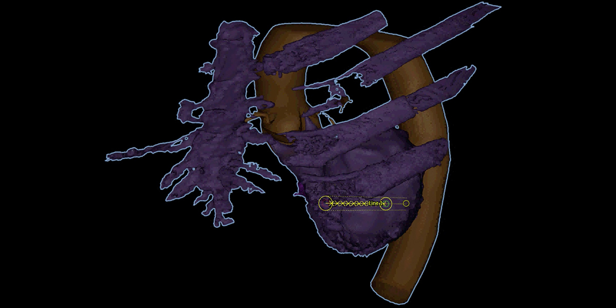Perivalvular Leak Closure