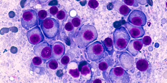 Pioneer MultMyeloma