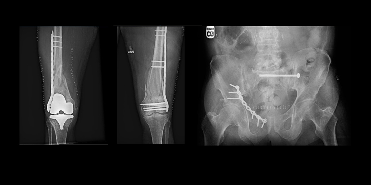 Ortho Trauma Case Study